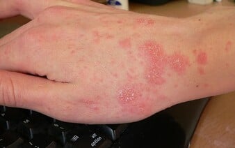 Svrab v Česku rekordně roste. Nejhůře je na tom Moravskoslezský kraj