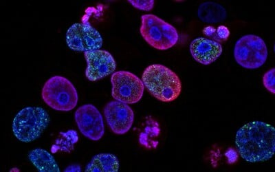 Unikátny objav českých vedcov. Vytvorili test, ktorý odhalí rakovinu pankreasu z kvapky krvi