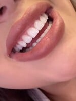 Úsmev ako z Instagramu: Kompozitná korekcia opraví medzery, tvar aj veľkosť zubov. Nemusí ťa to stáť tisíce