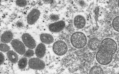 V Česku zemřel první pacient s opičími neštovicemi. Aktuálně je v zemi 66 případů