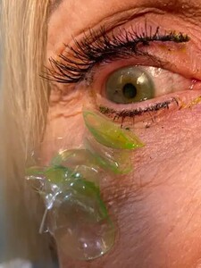 VIDEO: Lekárka pacientke z oka vytiahla 23 zabudnutých šošoviek. Žena iba zázrakom vyviazla bez komplikácií