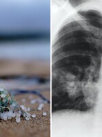 Vedci našli prvýkrát mikroplasty v ľudských pľúcach: Sme prekvapení, ako hlboko sa dostali, hovoria