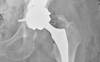 Veľký úspech lekárov z Bratislavy: Vykonali jedinečnú operáciu, ktorá sa na svete doteraz podarila len trikrát