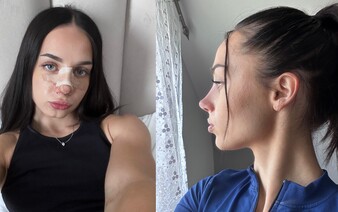 Veronika išla na plastiku nosa do Turecka: Objednala som sa cez WhatsApp, na poslednú chvíľu som zmenila lekára