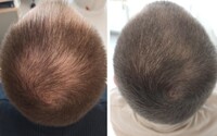 Vypadávanie vlasov je komplexný problém, pomôcť môžu lieky na predpis, plazmoterapia, ale aj zlepšenie domácej starostlivosti