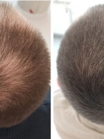 Vypadávanie vlasov je komplexný problém, pomôcť môžu lieky na predpis, plazmoterapia, ale aj zlepšenie domácej starostlivosti