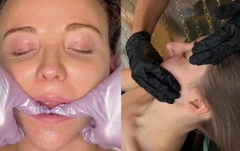 Vyskúšala som bukálnu masáž tváre, pri ktorej ti uvoľňujú svaly aj zvnútra úst. Môže nahradiť botox?