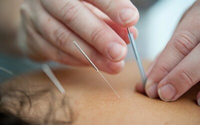 Vyzkoušeli jsme akupunkturu. Popisujeme, jak probíhá, zda je bolestivá a kolik peněz zaplatíš za jednu terapii (Reportáž)