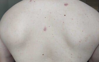 Zdanlivo neškodné znamienko môže byť varovaním. Kedy treba spozornieť?