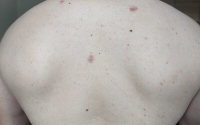 Zdanlivo neškodné znamienko môže byť varovaním. Kedy treba spozornieť?