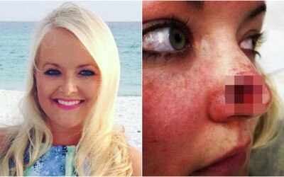Žena chodila do solária 3-krát týždenne počas 11 rokov. Diagnostikovali jej rakovinu a na nose sa jej vytvorila veľká diera