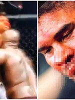 Zranění jako z hororu: Slavný MMA bojovník dostal ránu, která mu zcela roztrhla horní ret