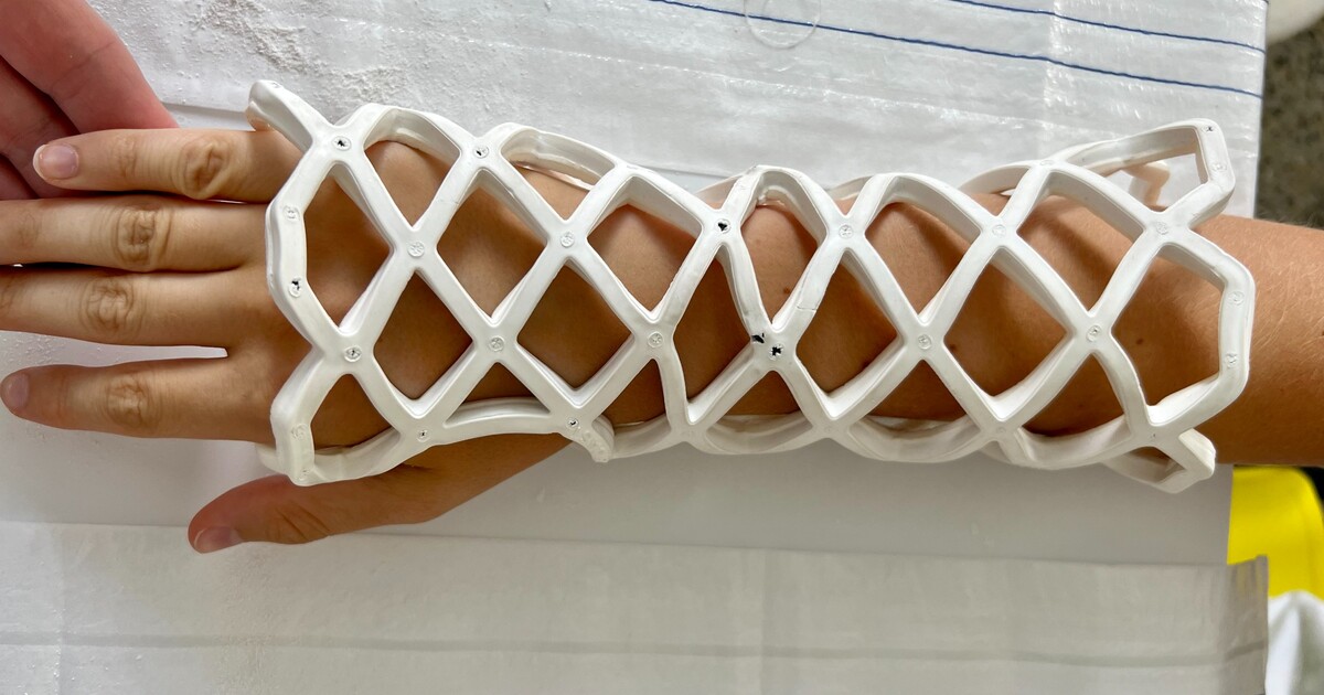 Na Bulovce dostaneš novou dlahu místo sádry, je lehká, prodyšná a můžeš se s ní i koupat