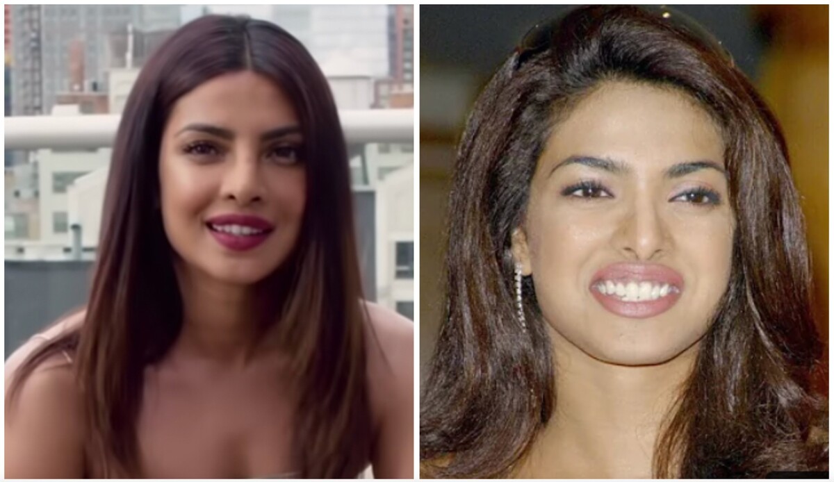 Priyanka Chopra pre nevydarenú plastiku nosa takmer prišla o kariéru. Začiatkom milénia ju vyhodili z troch filmov.