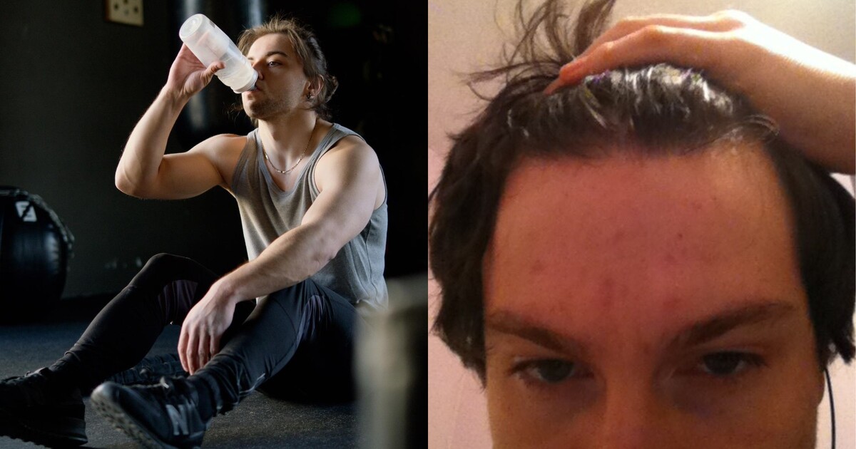 Příliš mnoho doplňků stravy je spojeno s výskytem těžkého akné a jizvami: Kdy třeba zpozornět?