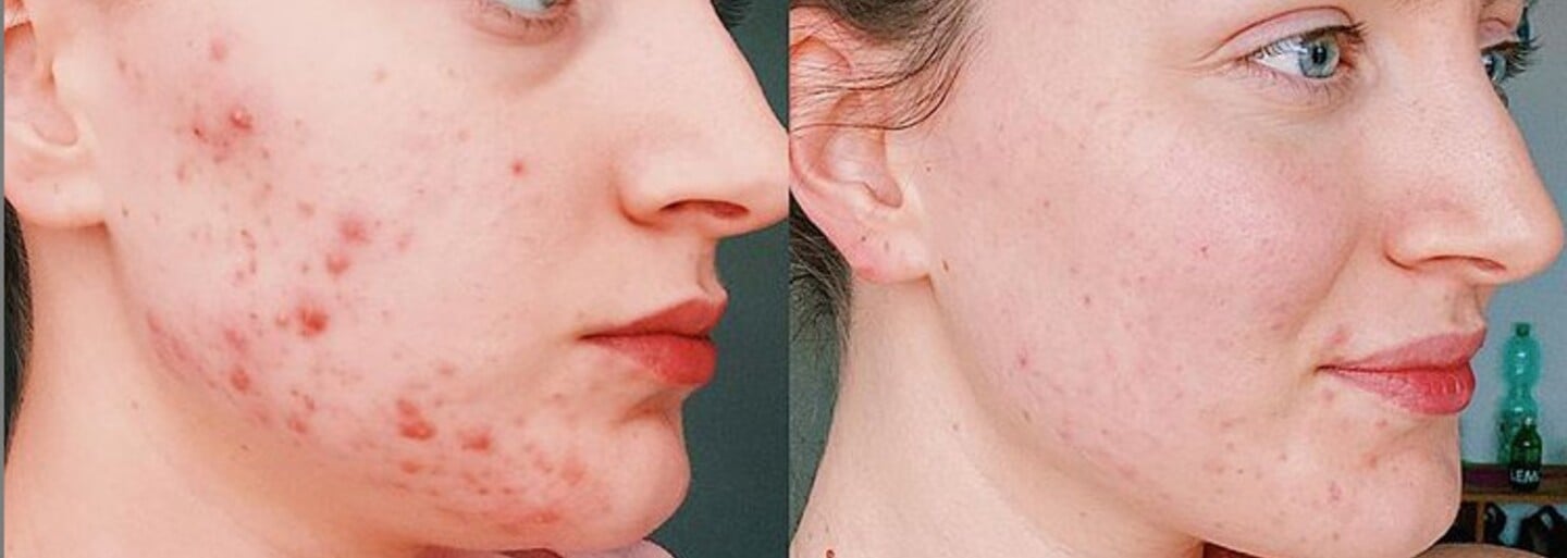 Acne Myth Busters: Sun Might Dry Your Pimples, But It Can Cause Even Bigger Problems