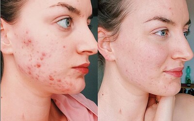Acne Myth Busters: Sun Might Dry Your Pimples, But It Can Cause Even Bigger Problems