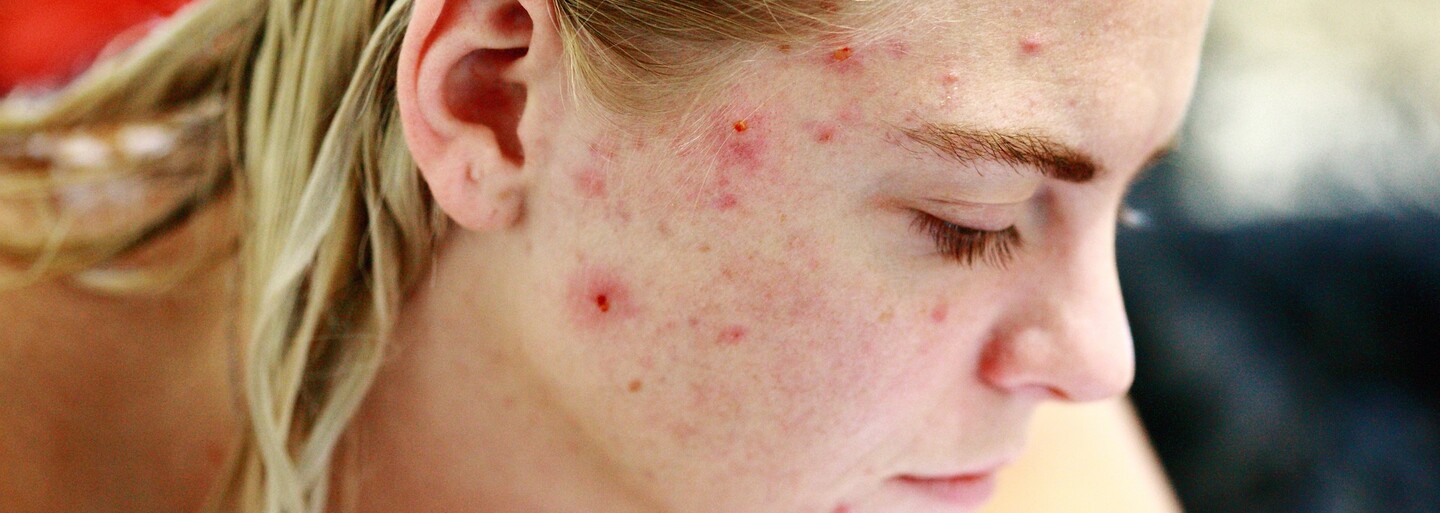 Akné na bradě značí hormonální nerovnováhu, na čele stres. Zeptali jsme odbornice, jak vzniká a jak jej léčit