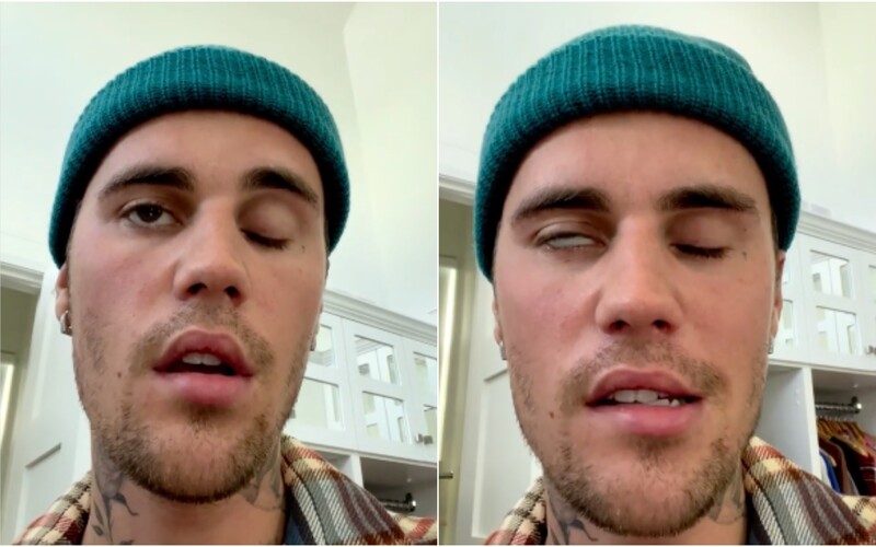 Justin Bieber musel zrušit koncerty, ochrnula mu polovina obličeje. „Tělo mi říká, že musím zpomalit,“ uvedl zpěvák.