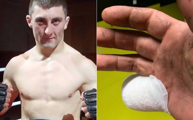 Bojovníkovi MMA odsekl kombajn kus malíčku. K lékaři šel až poté, co dokončil sklizeň Bojovníkovi MMA odsekl kombajn kus malíčku. K lékaři šel až poté, co dokončil sklizeň