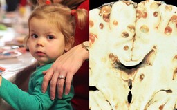 Bolesti hlavy a epileptické záchvaty spôsoboval mozog plný vajíčok pásomnice. Dlhé mesiace nevedeli, čo sa s dievčatkom deje