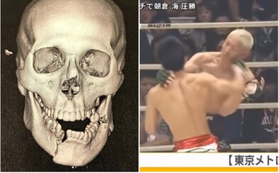Bývalý UFC bojovník utrpěl děsivou zlomeninu čelisti. Na Instagramu ukázal snímky z rentgenu Bývalý UFC bojovník utrpěl děsivou zlomeninu čelisti. Na Instagramu ukázal snímky z rentgenu