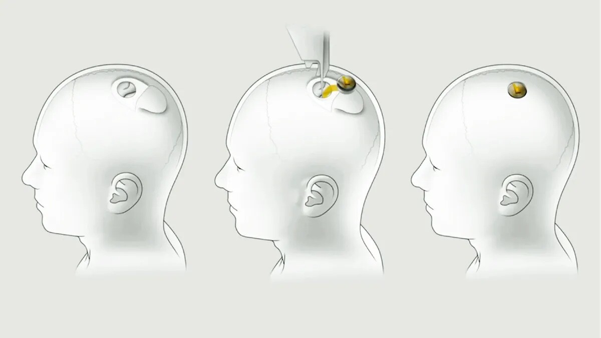 Mikročip s elektródami sa do mozgu bude implementovať pomocou malého rezu cez lebku.