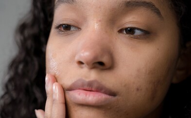 Can You Get Rid Of Acne Breakouts? Dermatologist Explains How To Care For Acne-Prone Skin 