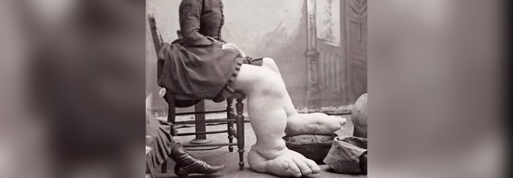 Fanny Mills měla nohy oteklé do velkých rozměrů. Vydělala si i 100 tisíc korun týdně