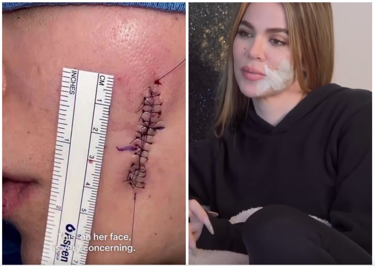 Khloé Kardashian sa s fanúšikmi podelila o šokujúce informácie týkajúce sa jej zdravotného stavu. Vysvetlila, prečo na tvári nosila bandáž a leukoplasty.