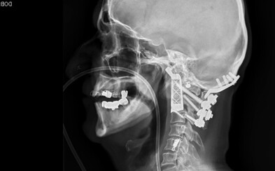 Chirurgové implantovali muži s rakovinou obratel z 3D tiskárny. Podobná operace se ještě nikdy neuskutečnila Chirurgové implantovali muži s rakovinou obratel z 3D tiskárny. Podobná operace se ještě nikdy neuskutečnila