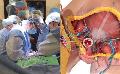 Chirurgové zvládli nejkomplexnější transplantaci penisu a šourku. Válečný veterán o genitálie přišel při výbuchu Chirurgové zvládli nejkomplexnější transplantaci penisu a šourku. Válečný veterán o genitálie přišel při výbuchu