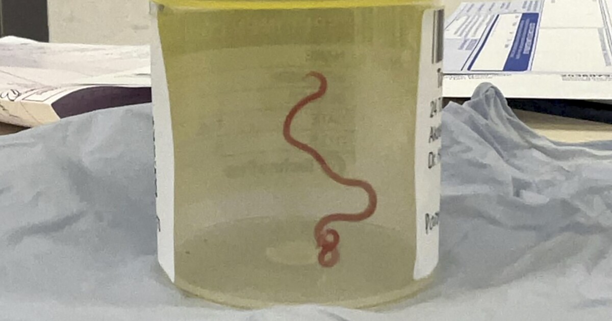 Světový unikát: Žena měla v hlavě osm centimetrů dlouhého červa. Po vyjmutí z těla se ještě hýbal