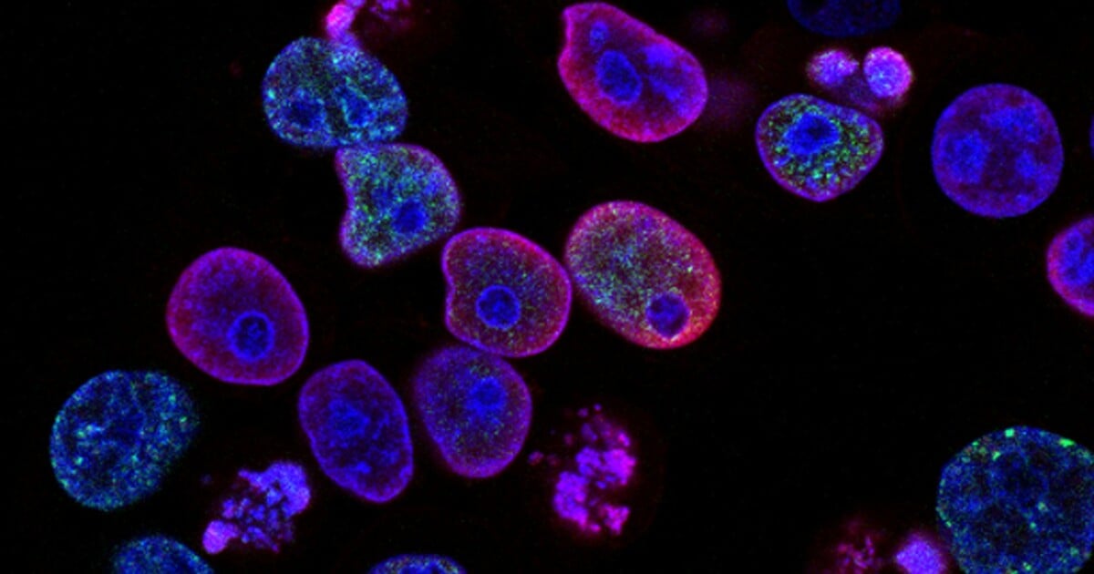 Unikátní objev českých vědců. Vytvořili test, který odhalí rakovinu slinivky z kapky krve