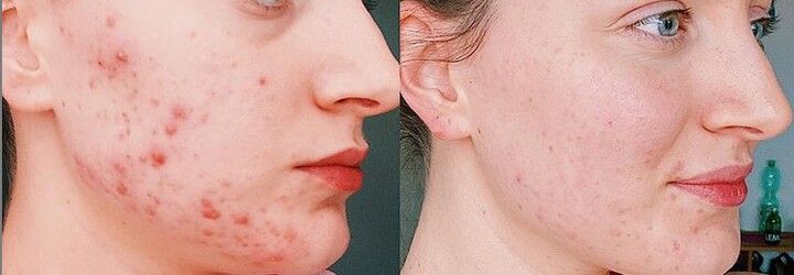 Najväčšie mýty o akné: Slnko ti síce môže vysušiť vyrážky, ale spôsobí ti ešte väčšie problémy