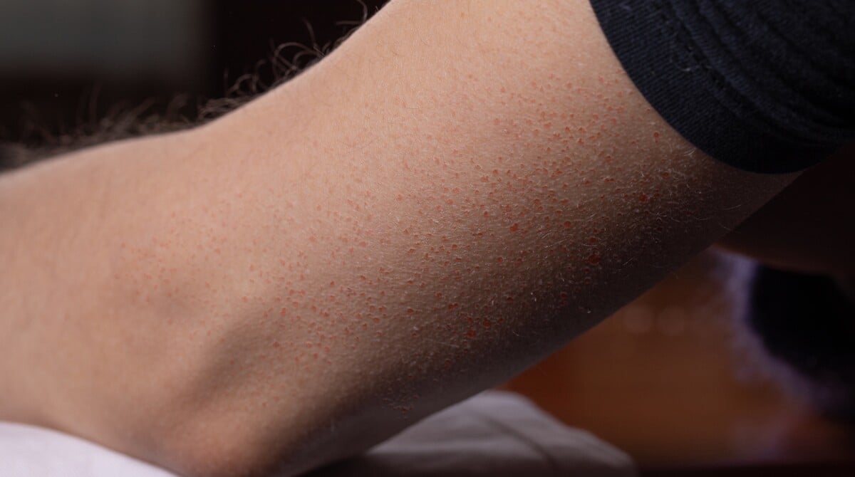 keratóza pilaris