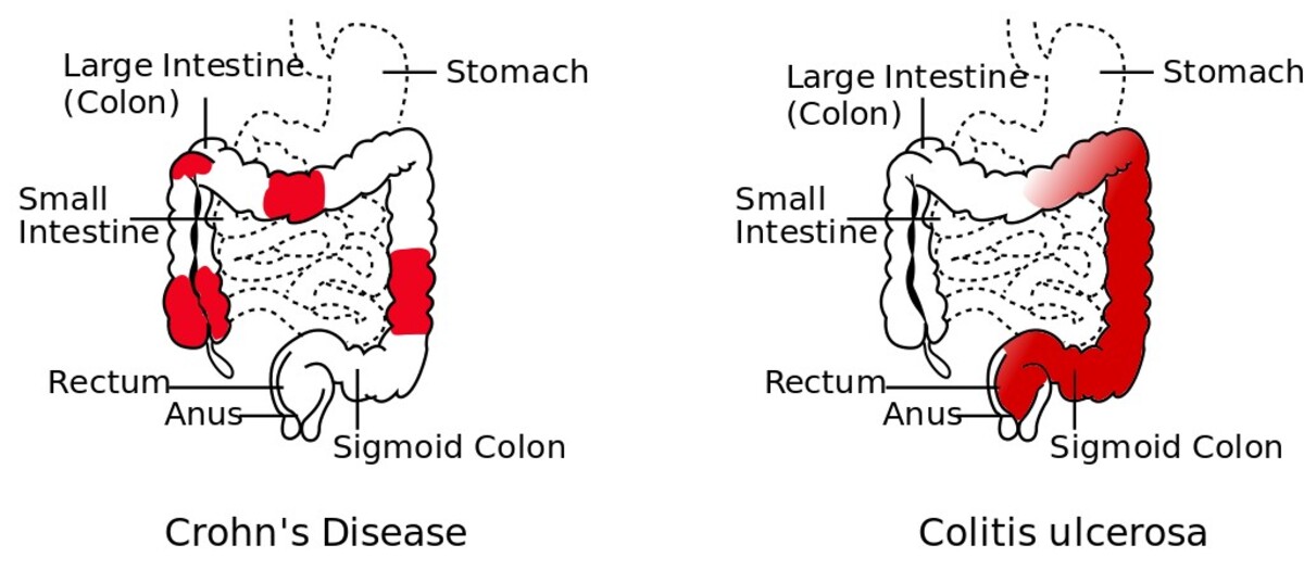 Rozdiel medzi Crohnovou chorobou a ulceróznou kolitídou.