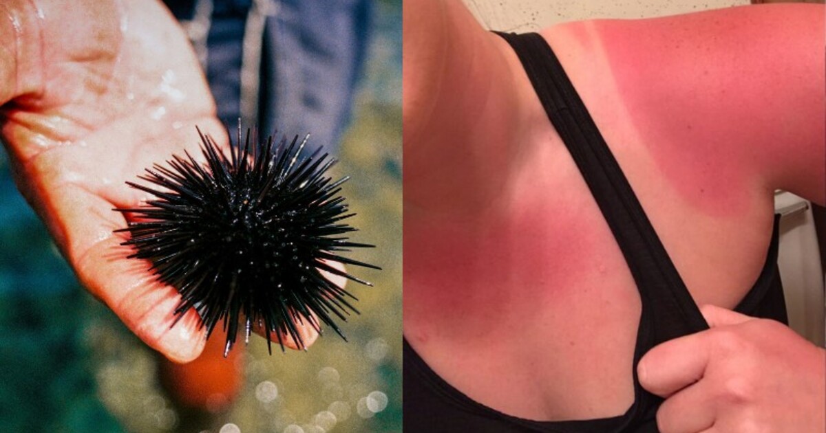 First aid summer: Před těmito věcmi je nutné se v létě umět chránit