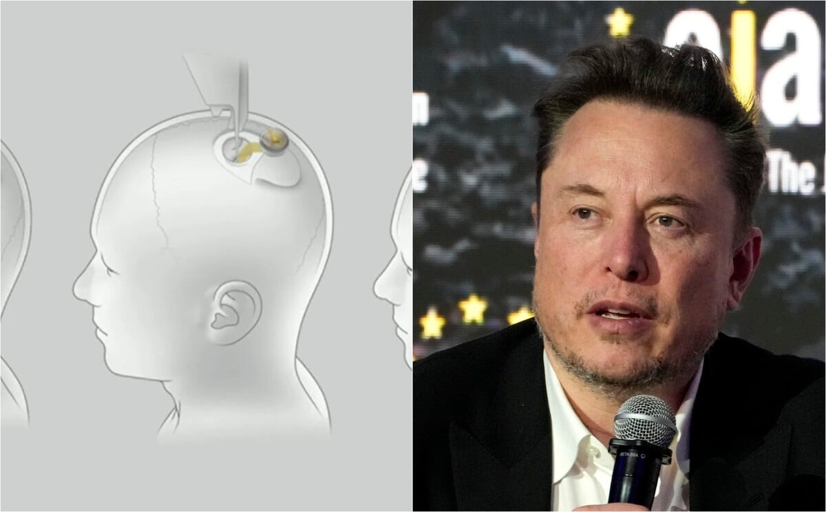 Elon Musk Neuralink čip