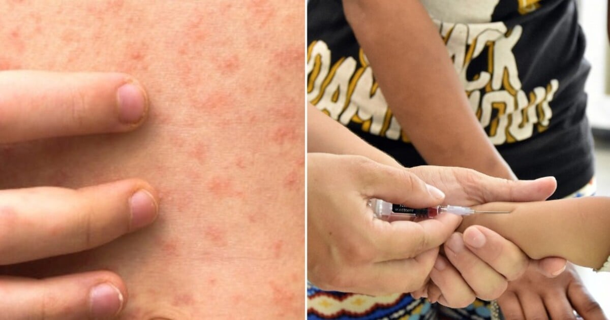 Nebezpečné virové onemocnění opět ohrožuje Evropu. WHO vyzývá k očkování