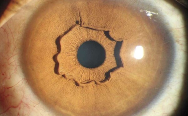 A rövidlátás (myopia)