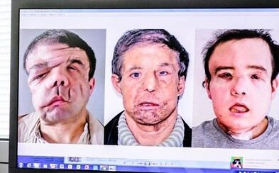 Francúz sa stal prvým človekom, ktorý podstúpil dve transplantácie tváre. Tri mesiace ležal na lôžku a nemohol vidieť, počuť a hovoriť Francúz sa stal prvým človekom, ktorý podstúpil dve transplantácie tváre. Tri mesiace ležal na lôžku a nemohol vidieť, počuť a hovoriť