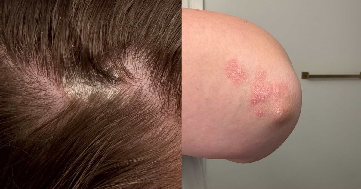 Katka žije s lupénkou: „Nevlastní matka mi řekla, že si jen neumím umývat vlasy. Spouštěčem onemocnění byl stres“