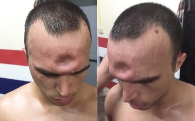 Jeremy utrpěl v thajském boxu nepříjemné zranění, ale i tak chtěl pokračovat. Zlomeninu lebky zachycuje i video ze zápasu Jeremy utrpěl v thajském boxu nepříjemné zranění, ale i tak chtěl pokračovat. Zlomeninu lebky zachycuje i video ze zápasu