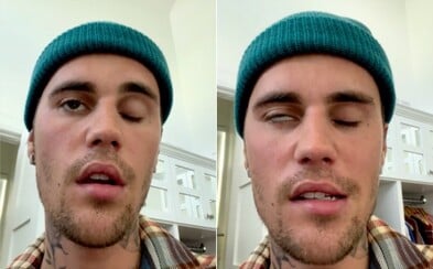 Justin Bieber Revealed Illness That Paralyzed Half Of His Face. He Is Cancelling Concerts