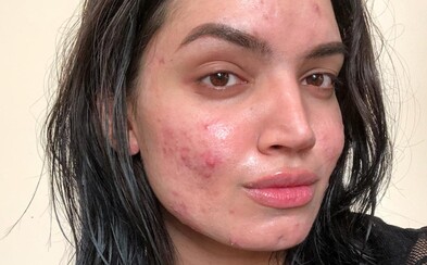 L'Oréal urazil blogerku, protože prý nemůže být spojován s lidmi trpícími akné. Výrobce kosmetiky si způsobil skandál necitlivým vzkazem L'Oréal urazil blogerku, protože prý nemůže být spojován s lidmi trpícími akné. Výrobce kosmetiky si způsobil skandál necitlivým vzkazem