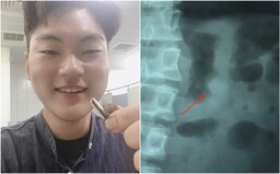 Muž prehltol AirPod počas spánku. Slúchadlo mu hralo v tele a keď ho „dostal von“, stále bolo funkčné