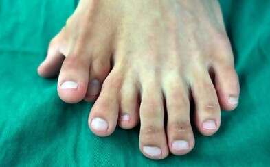 Muž se narodil s devíti prsty na noze. Operaci kvůli rodičům odkládal až do 21 let Muž se narodil s devíti prsty na noze. Operaci kvůli rodičům odkládal až do 21 let