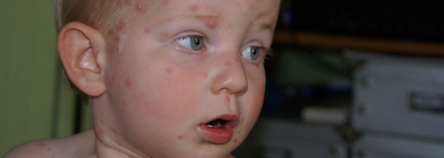 Na jižní Moravě hygienici evidují u dětí osmkrát víc neštovic než loni