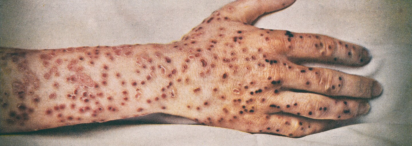 Nejsmrtelnější virus v dějinách: Na pravé neštovice umřelo víc lidí než ve všech válkách v dějinách lidstva